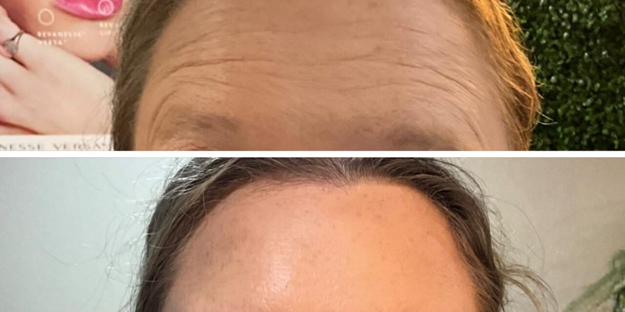 Botox1