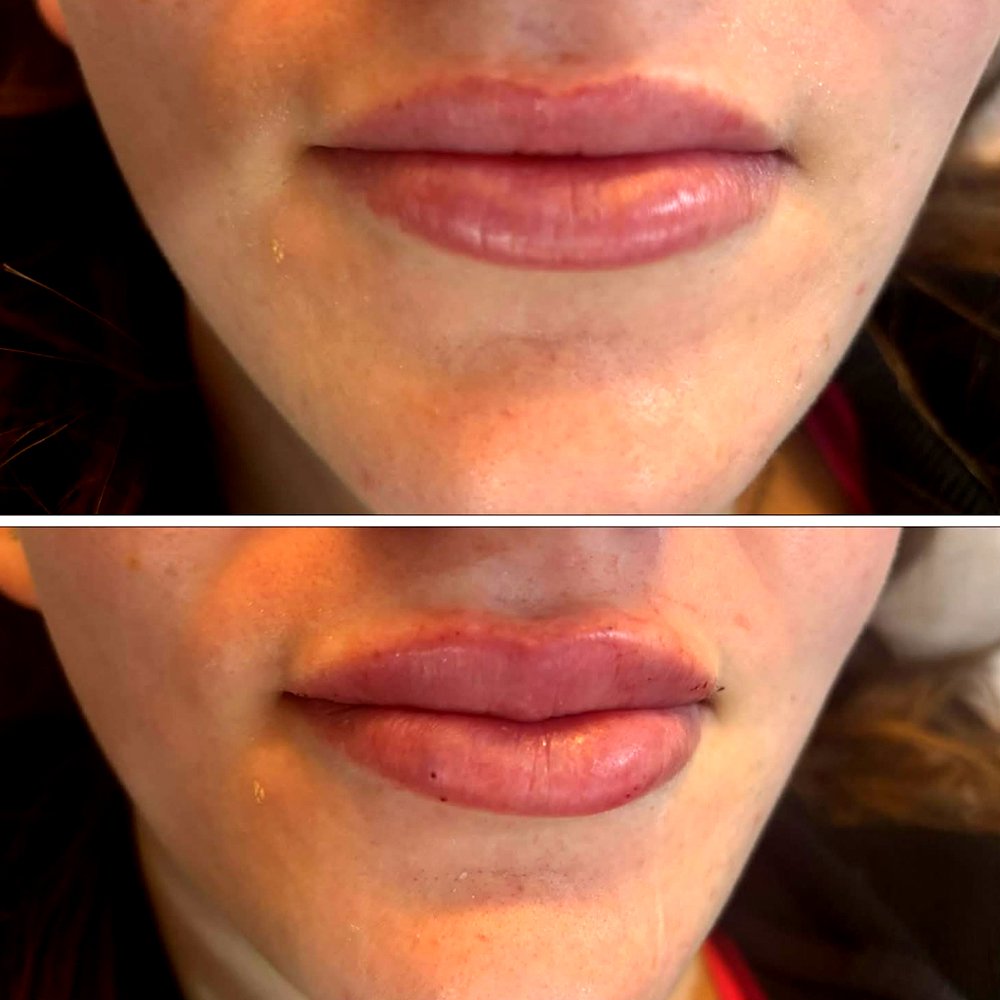 LipFiller1