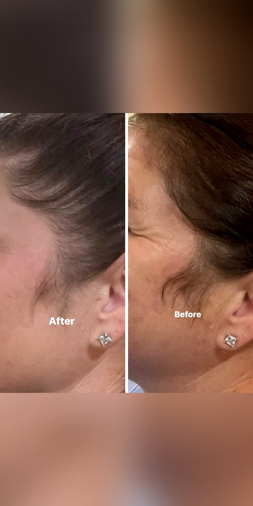 botox2